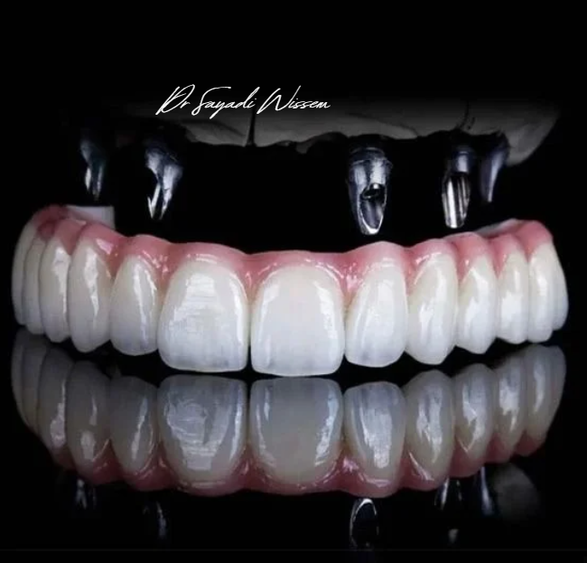 Implants dentaires
